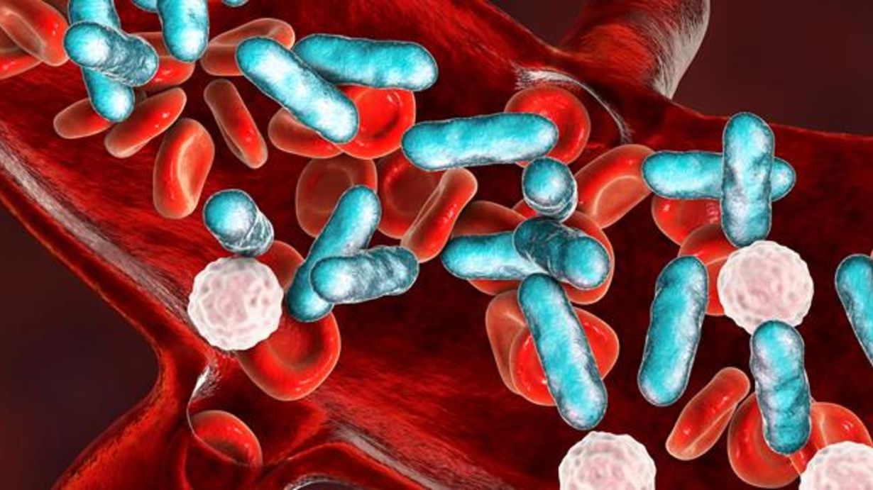 30 Fakta Om Sepsis
