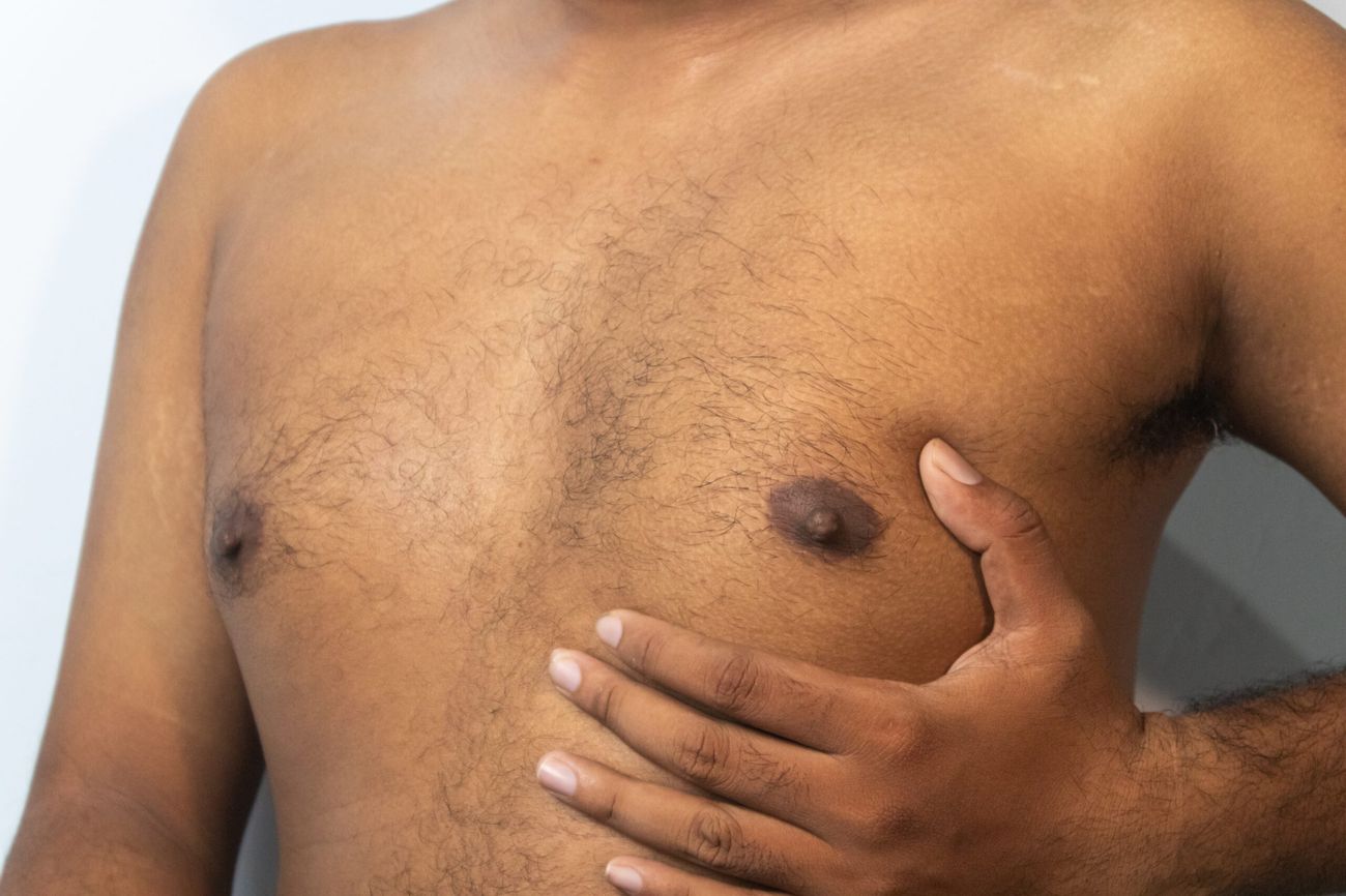 34 Fakta Om Gynekomasti