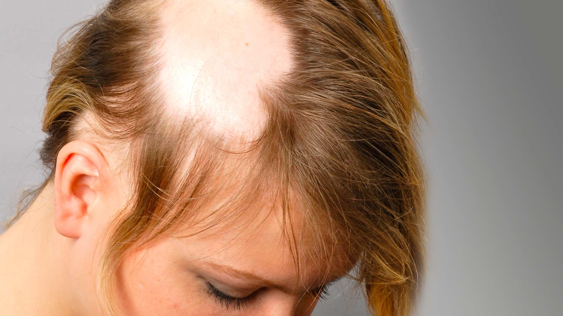 36 Fakta Om Alopeci