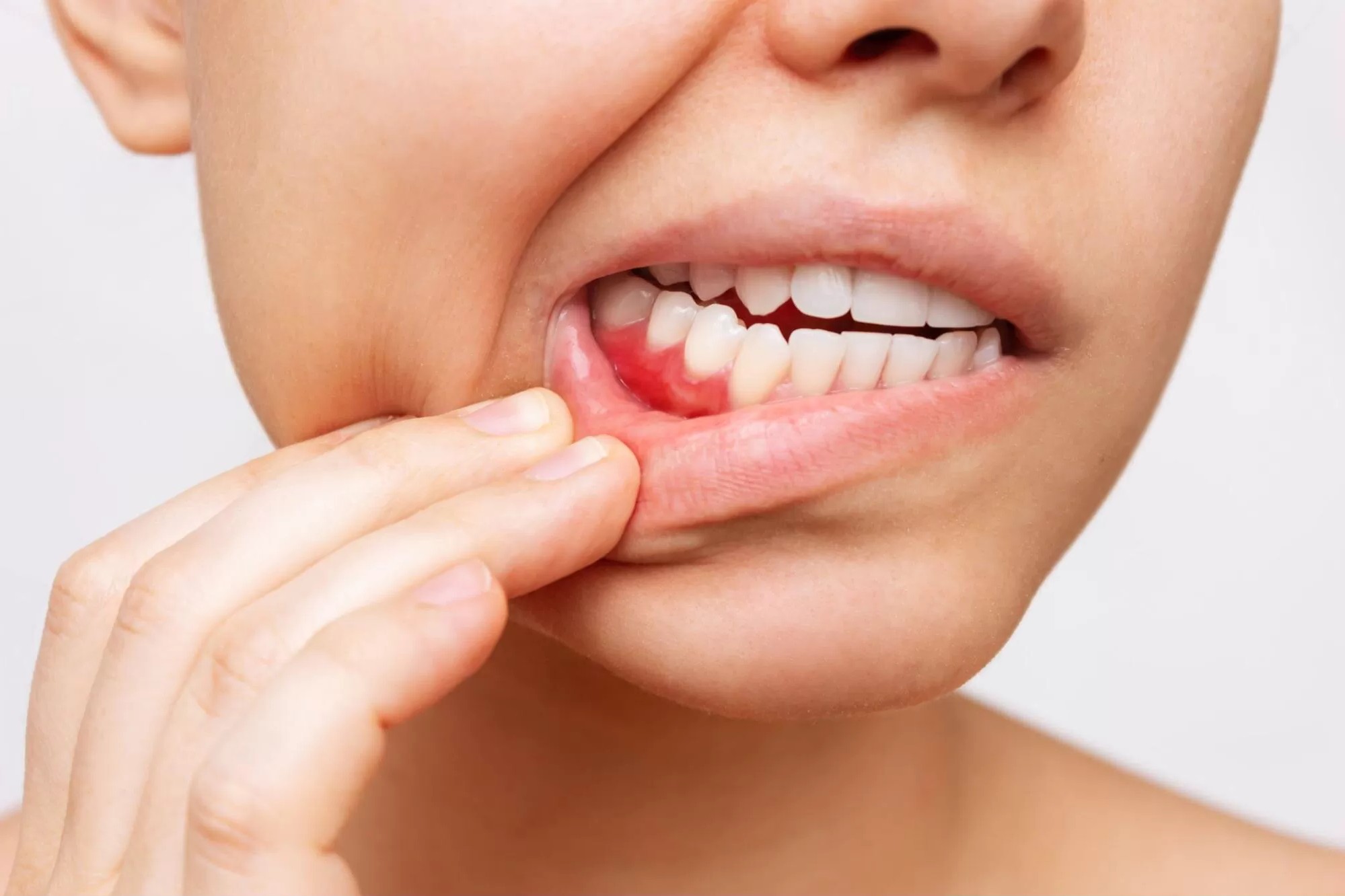 36 Fakta Om Gingivitt